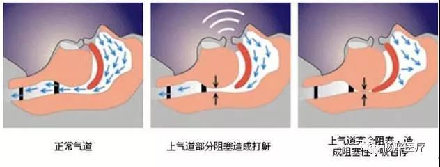 我國3000萬高血壓患者都有這毛??！你知道嗎？